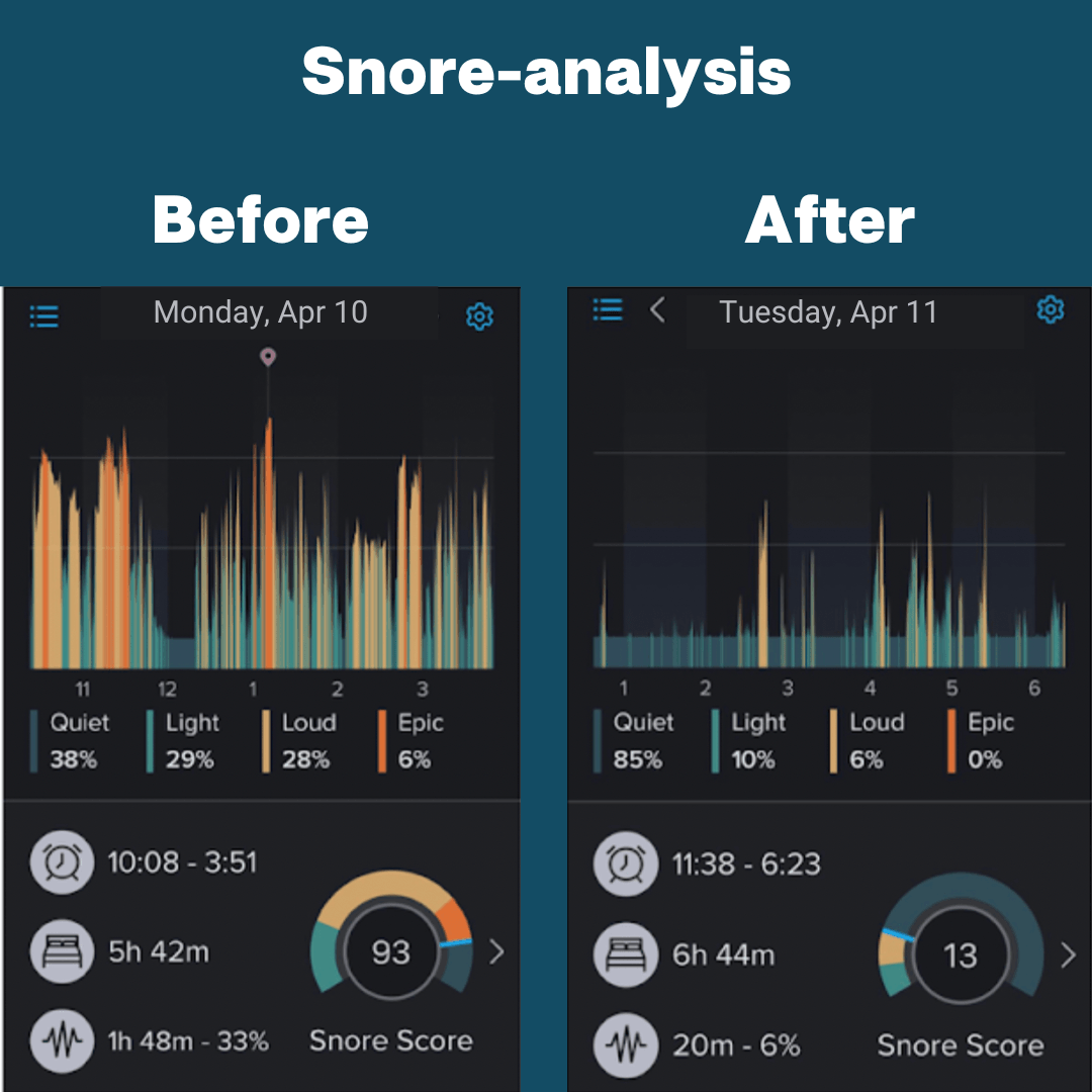 Bundle - Transparant Nose Strips & Mouth tape - Zippit