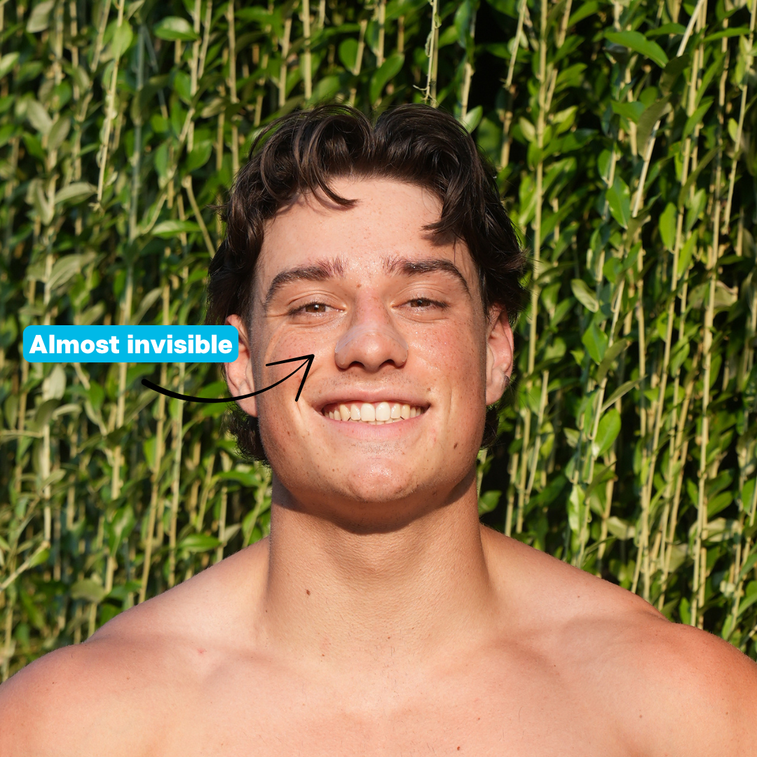 Sniffit® Transparent nasal strips